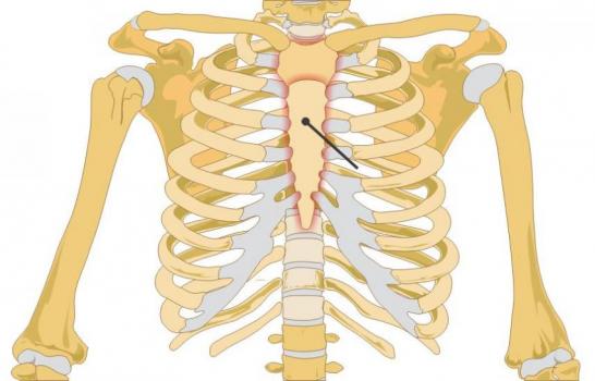 肋软骨炎发生部位图片图片